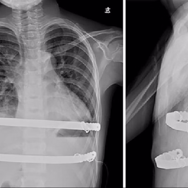 Living with the bars: Is it uncomfortable?