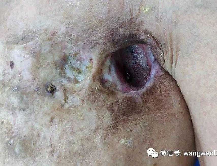 Repair and Reconstruction of Chest Wall Defect