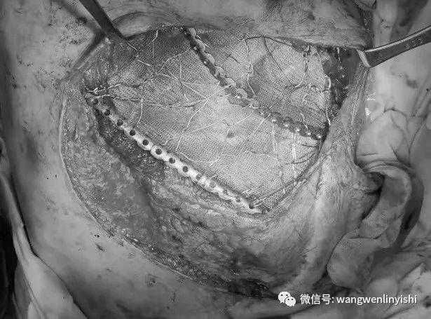 The surgery was completed