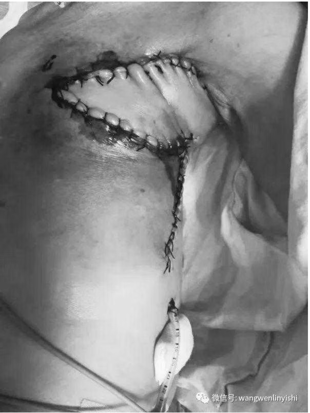 Appearance of the incision after the surgery