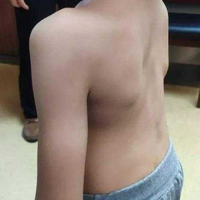 Loss of normal spinal curvature