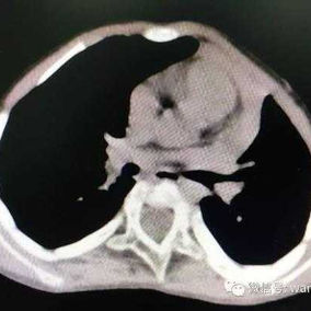 The CT scan shows a convex deformity of the chest wall
