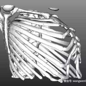 The 3D image shows a protruding anterior chest wall