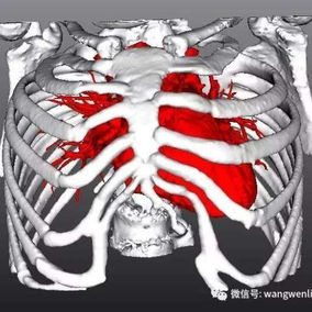 The 3D image illustrates the spatial relationship between the chest wall and the heart