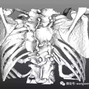 The 3D images shows a significant spinal abnormality
