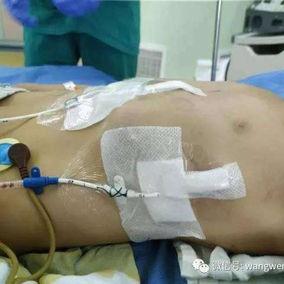 The deformities were corrected and the chest wall returned to normal after the surgery