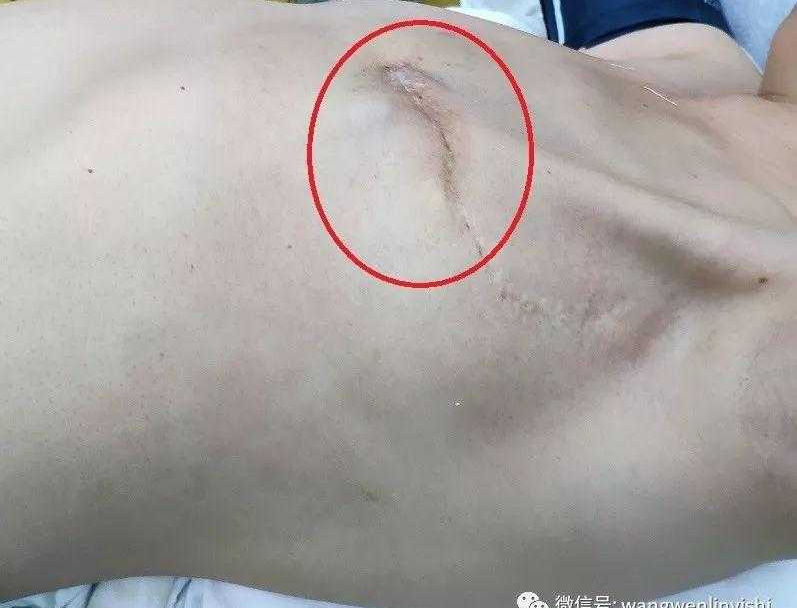 Chest Wall Tumor Resection and Chest Wall Reconstruction in A Middle-aged Female Patient