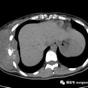 The CT scan shows that the tumor is located on the right chest wall