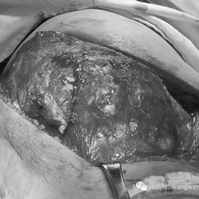 Exposure of the tumor on the right chest wall during the surgery