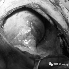 An extensive defect in the right chest wall after tumor resection, with the right diaphragm and lung tissue visible