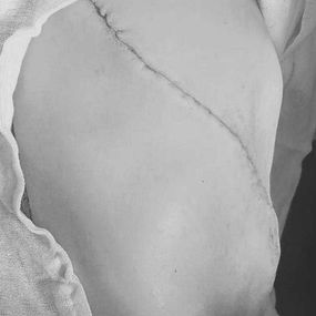 The incision was closed, marking the end of the surgery.