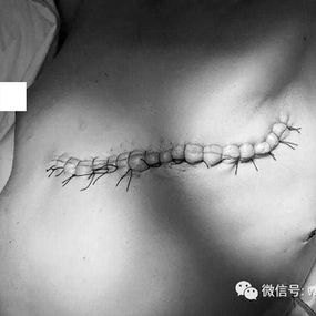 The surgery was completed