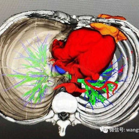 The 3D image illustrates the positional relationship between the tumor, heart, and mediastinum