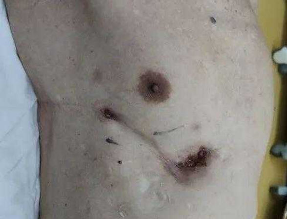 The Third Surgery for A 60-year-old Patient with Chest Wall Infection