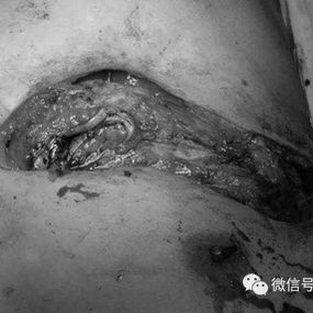 Complete removal of necrotic structures