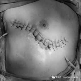 The incisions were sutured, and the surgery was completed