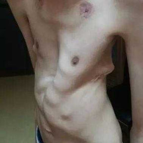 The deformity is more severe when seen from the lateral side, with a shortened anterior-posterior diameter. The outline of the bar from the Nuss surgery is visible.