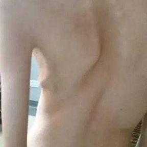 Obvious scoliosis of the spine and bilateral asymmetry of the chest.