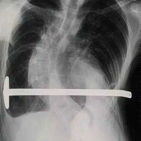 The X-ray shows the shadow of the bar from the Nuss surgery, along with scoliosis and asymmetry of the chest wall.