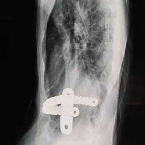The X-ray shows complex chest wall deformities, with a clearly shortened distance between the sternum and the spine.