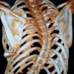 The 3D reconstruction indicates scoliosis and asymmetry of the chest wall.