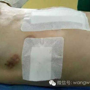 The chest wall appearance essentially returned to normal after the surgery, with the deformities eliminated.