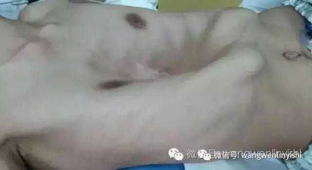 severe chest wall deformities before the surgery