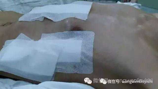 The chest wall appearance essentially returned to normal postoperatively