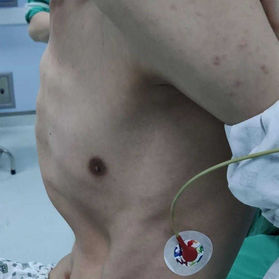 Preoperative chest wall appearance