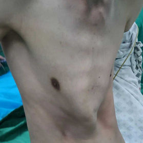 chest wall deformed severely