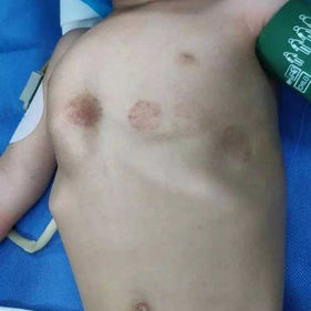 Preoperative chest wall appearance