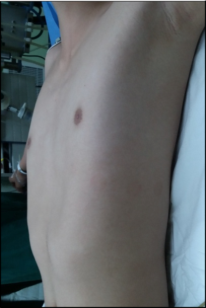 Flattened anterior chest wall