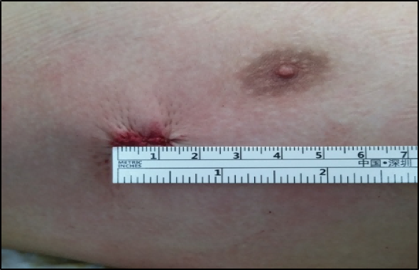 The surgical incisions are only 1.5cm long