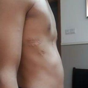 Typical groove-like depression is present, with two old surgical scars visible on the right chest wall.