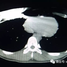 CT scan shows the fixation site of the bar in the right side of the chest wall.