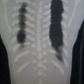 CT scan shows asymmetry of the chest wall on both sides and mild scoliosis of the spine.