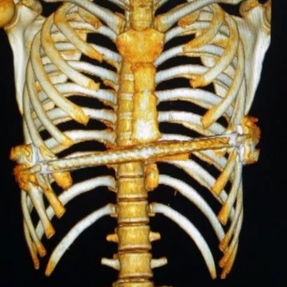 3D reconstruction shows the slanted position of the bar.