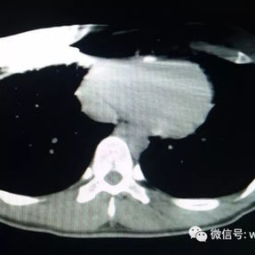 CT scan showing the both ends of the bar has integrated into the soft tissues.