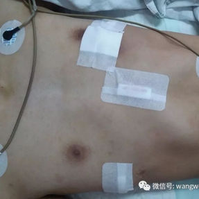 The chest wall was returned to its normal shape after surgery.