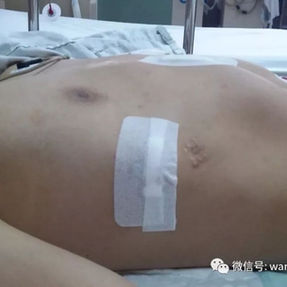 The chest wall deformity disappeared after the surgery.