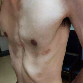 The anterior chest wall is concave, and the depression is in the shape of a distinct groove, which is completely different from the pit of PE.