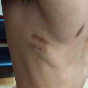 Old surgical scars on the lateral chest wall