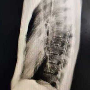 The X-ray indicates a depression in the lower part of the anterior chest wall