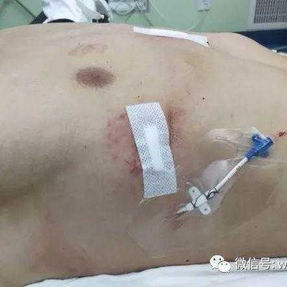 The chest wall deformity was corrected after the surgery