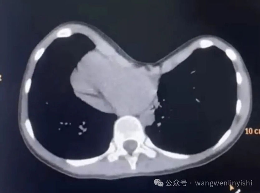 Severe asymmetric chest wall depression with rightward displacement of the heart and marked cardiac compression