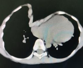 Acute angle deformities at both the edge and bottom of the depression
