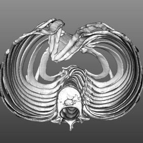 Acute angle deformities at both the edge and bottom of the depression