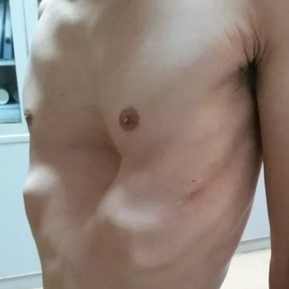 Preoperative appearance of the chest wall