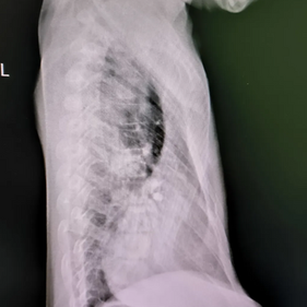 The lowest point of the chest wall depression extends beyond the anterior edge of the spine