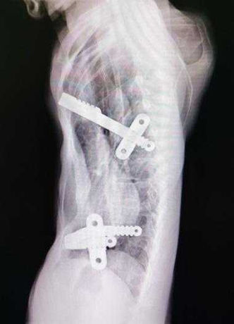 Preoperative X-ray showing anterior chest wall depression with significant heart compression. It can be observed that two Nuss bars are not positioned at the bottom of the depression.